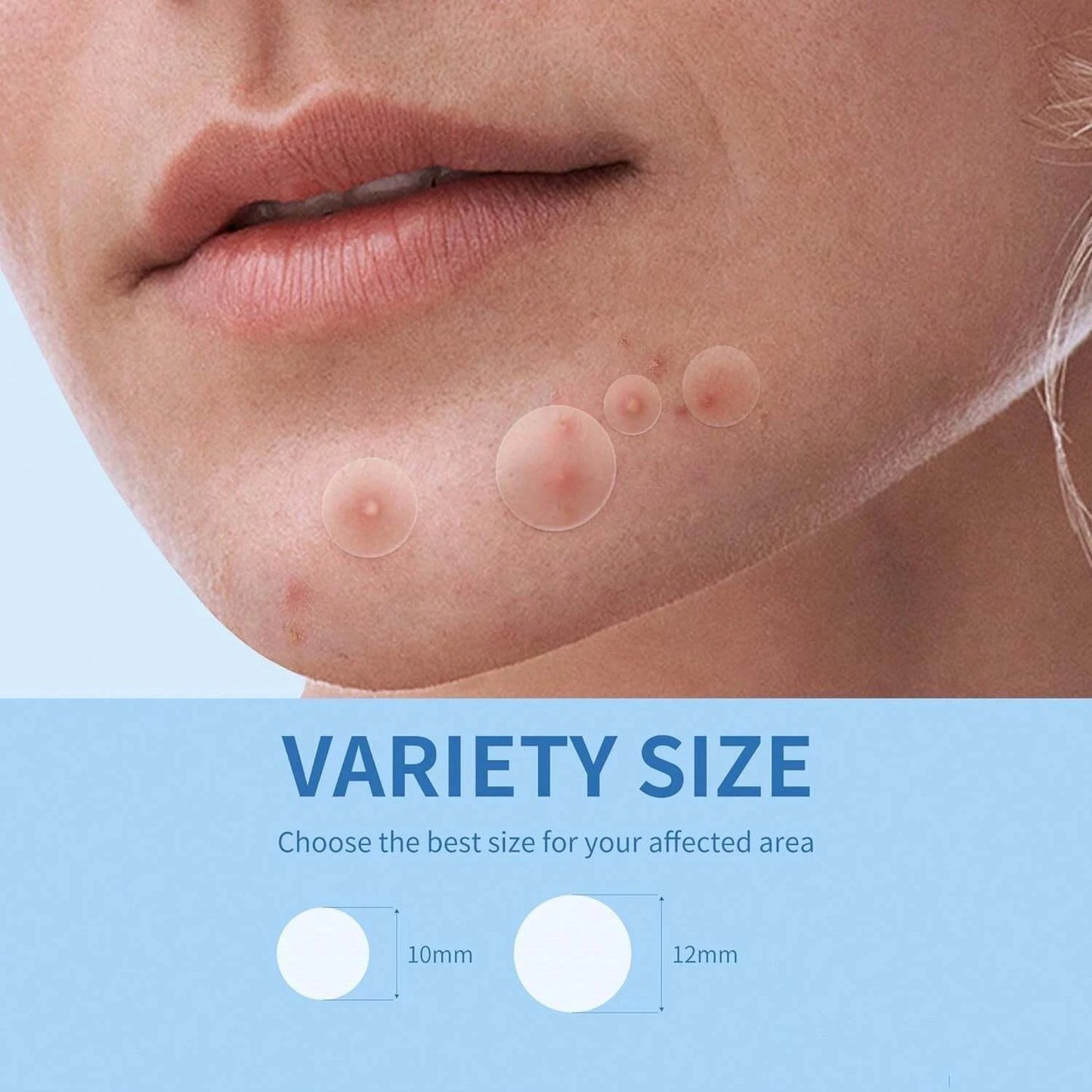 Hydrocolloid Acne Patches — Cover Blemishes & Speed Up Healing