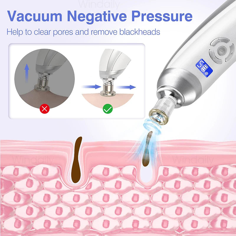 Diamond Microdermabrasion Machine — Clears Blackheads & Refines Pores