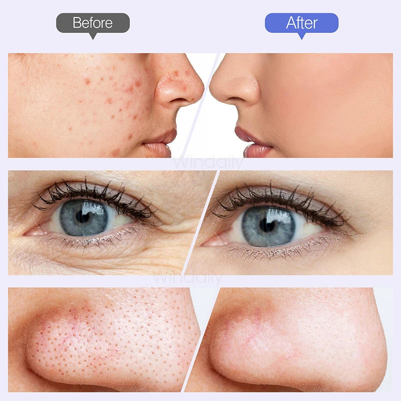 Diamond Microdermabrasion Machine — Clears Blackheads & Refines Pores