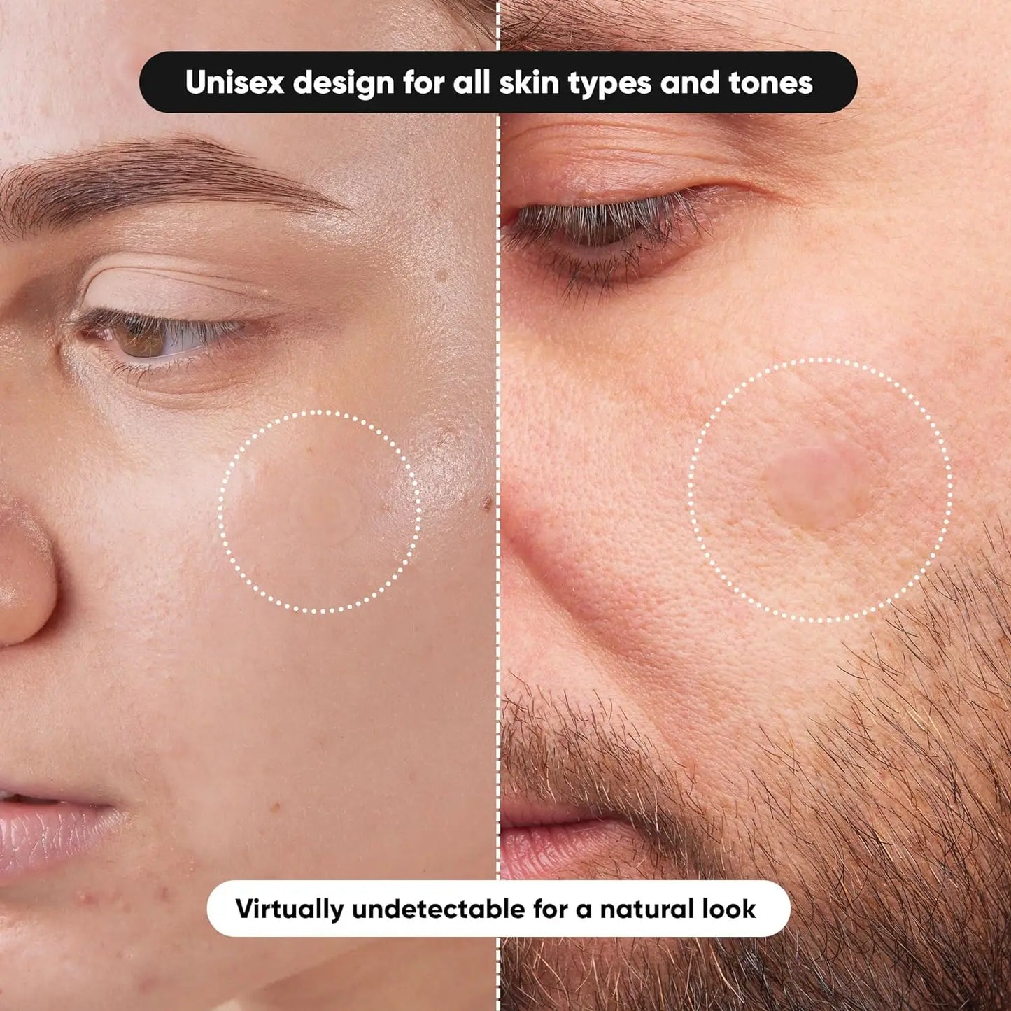 Hydrocolloid Acne Patches — Cover Blemishes & Speed Up Healing